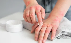 skinburn treatment in zirakpur