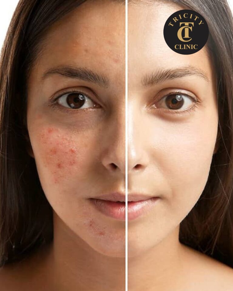 The Ultimate Guide to Acne Scar Removal Treatment in Zirakpur: Get Smooth Skin at Tricity Clinic
